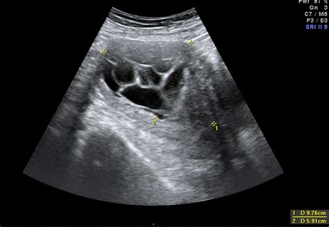 Fibroid rahim berlaku kerana tumor jinak yang boleh menyerang sistem pembiakan wanita. Bab 2 - Fibroid Rahim - Melaka Fertility - Selva's ...