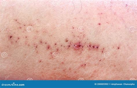 Close Up Of Man With Scab Wound Royalty Free Stock Photo