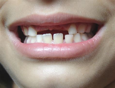 What To Do When Your Childs Baby Tooth Gets Knocked Out Oral Answers