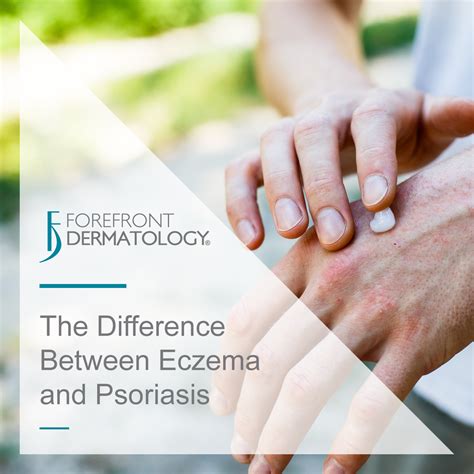 The Difference Between Eczema And Psoriasis Forefront Dermatology