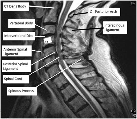 Cervical Mri Anatomy