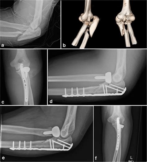 Plate Fixation And Radial Head Arthroplasty Of A Complex Olecranon