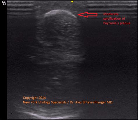 Penile Ultrasound With Doppler For Evaluation Of Peyronies Disease