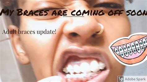 Adult Braces Update My Braces Are Coming Off Soon Youtube