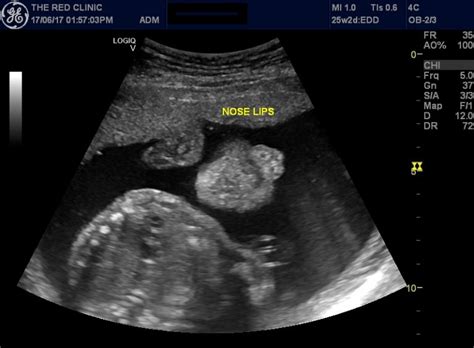 DETAILED SCAN IN PREGNANCY The Red Clinic