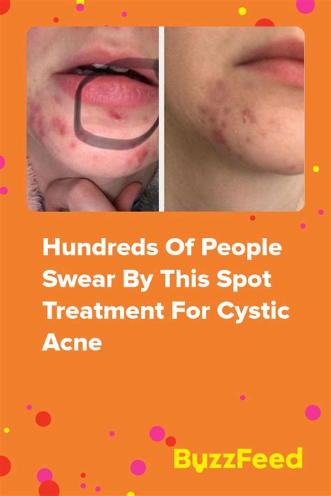 Hundreds Of People Swear By This Spot Treatment For Cystic Acne Artofit