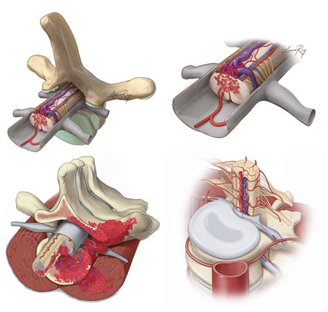 Spinal Cord Dural Arteriorvenous Fistulas The Neurosurgical Atlas