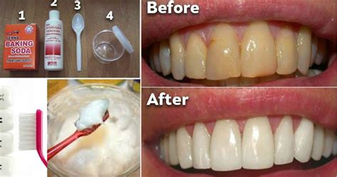 Having plaque on your teeth can not only be unsightly, but it can be unhealthy. How To Remove Plaque From teeth Without Expensive ...