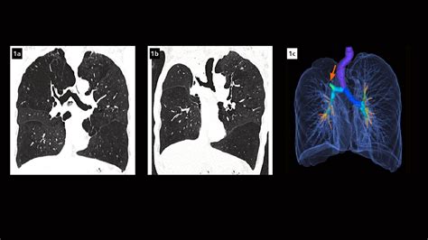Severe Emphysema Treated With Endobronchial Valves Siemens