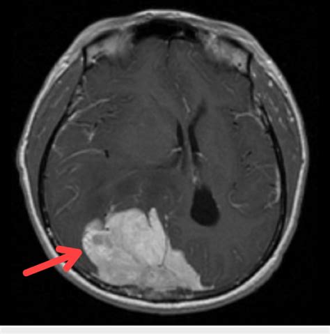 Magnetic Resonance Imaging Showed A Huge Right Occipital Lobe Tumour