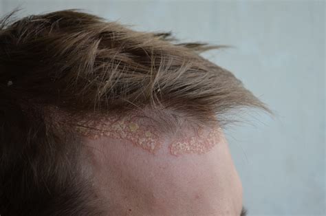 Scalp Psoriasis Forehead Hairline Psoriasis Cure Now