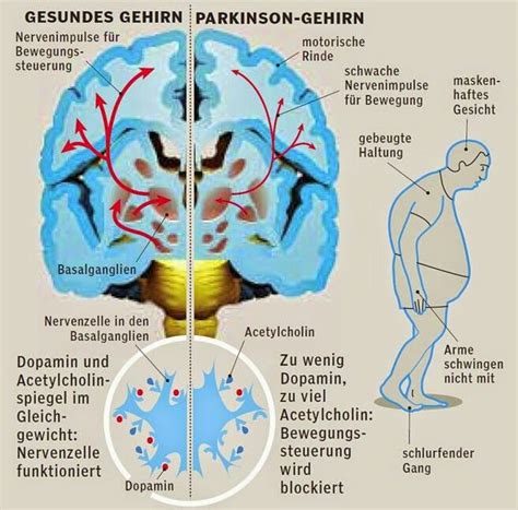 Parkinson Demenz Ursachen