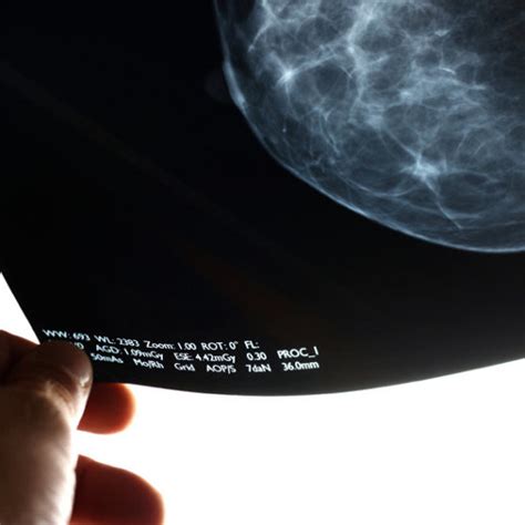 American Cancer Society Recommends Later Less Frequent Mammograms