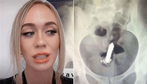 Tiktok Star Stuns By Revealing She Needed Surgery To Remove Vibrator From Her Rectum Newshub