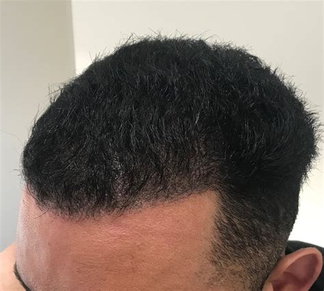 Methods include fut (follicular unit transplant) and fue (follicular unit extraction). Afro hair transplant Westminster clinic