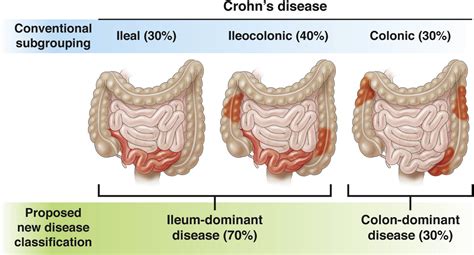 Should We Divide Crohns Disease Into Ileum Dominant And Isolated