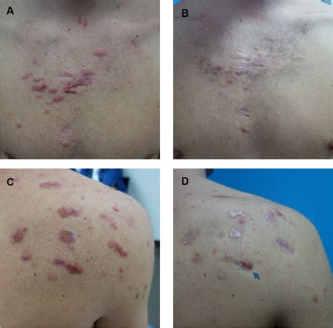 A 21 Year Old Man With Erythematous Post Acne Keloids On The Chest And
