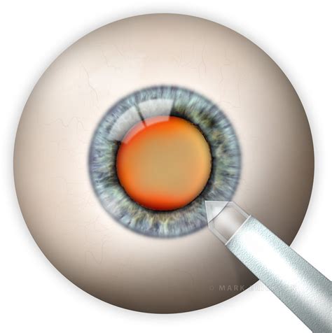 Clear Corneal Incision Early Step In Cataract Surgery
