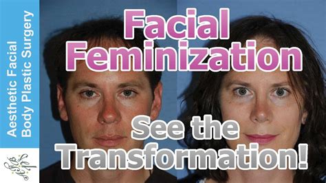 Transgender Facial Feminization FFS MTF M2F Plastic Surgery Video By