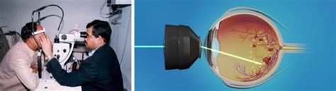 Retinal Laser Photocoagulation Sharnam Eye And Laser Services