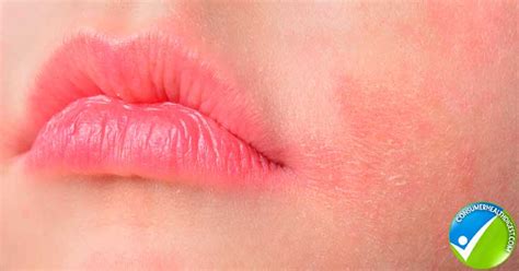 Itchy Burning Lips 7 Natural Remedies To Try At Home