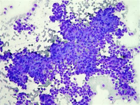 Ductal Cell Breast Carcinoma