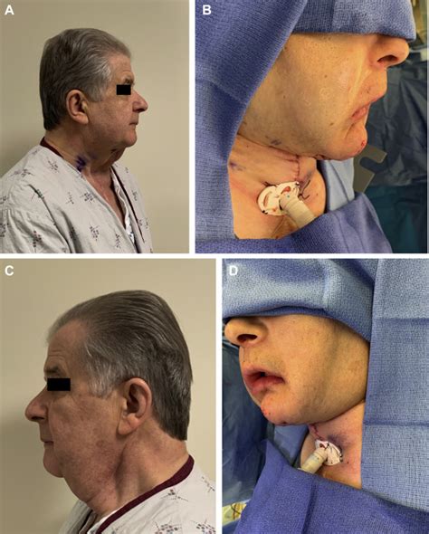 Vertical Submental Island Flap For Head And Neck Reconstruction