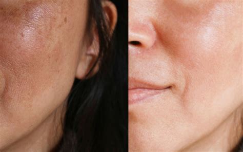 Melasma What Are The Symptoms And Best Treatments
