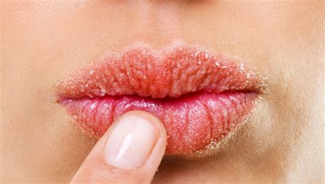 How Do You Treat Itchy Lips Naturally