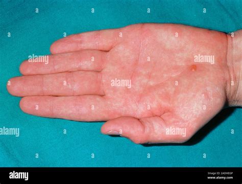 Skin Disorder The Palm Of An Hand Affected By A Mild Form Of Pompholyx
