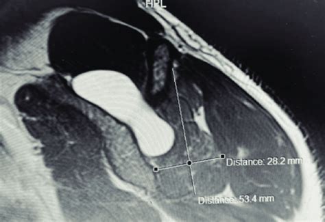 T2 Weighted Image Showing A Spinoglenoid Cyst Over The Supraspinous