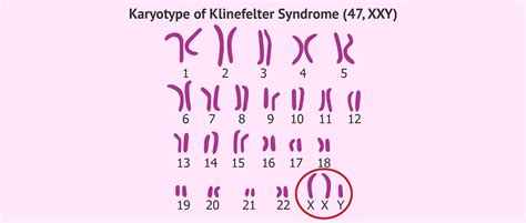 Klinefelter Syndrome X Chromosome Health Information