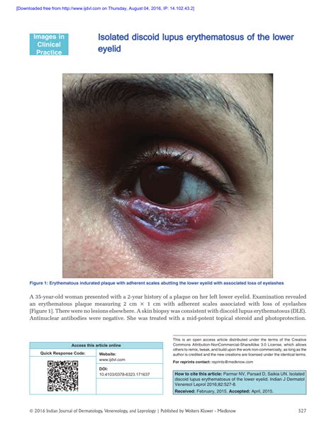 Pdf Isolated Discoid Lupus Erythematosus Of The Lower Eyelid