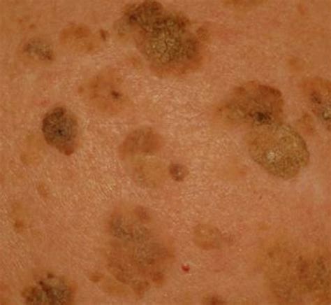 Seborrheic Keratosis Pictures Symptoms Treatment Removal And Hot Sex Picture