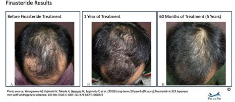 Best Topical Finasteride Does It Work For Hair Loss Fin Vs Fin