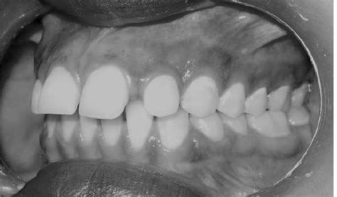 B Intraoral Right Lateral Occlusion Photograph Before Treatment