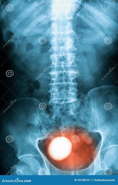 X Ray Of Plan Abdomen Supine Position Stock Image