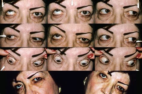 Left Inferior Oblique Palsy American Academy Of Ophthalmology