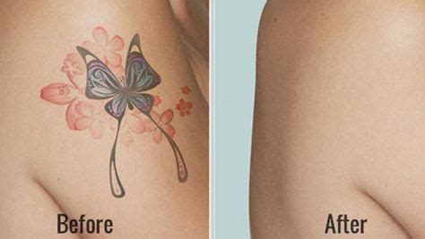 Laser tattoo removal is the safest and most effective means of eliminating an unwanted tattoo. How To Remove Tattoos At Home Fast #tattooremovaldiy | Tattoo removal cost, Diy tattoo permanent ...