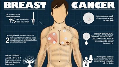 Breast Cancer In Men Rare But Still Gets Diagnosed Nabj