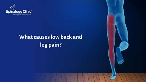 What Causes Low Back And Leg Pain Spinalogy Blogs Best Back Pain