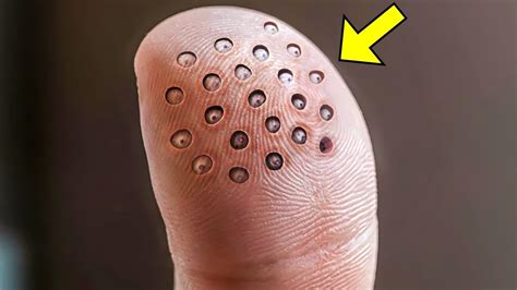 Man Has Weird Round Spots On Finger When The Doctors See It They Call