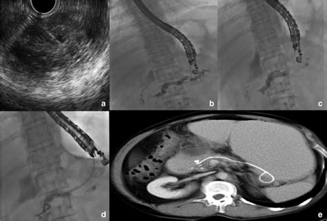 Eus Guided Pancreaticogastrostomy A Eus Guided Puncture Of The