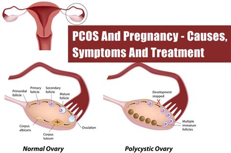 Pcos is characterized by hyperandrogenism, irregular ovulatory cycles. Gynaecologist | Park Hospital