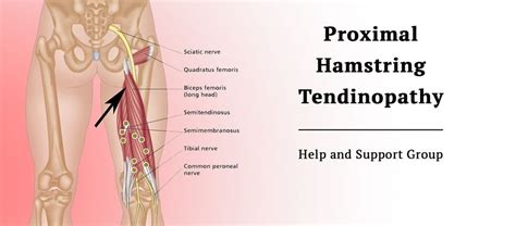 Proximal Hamstring Tendinopathy Proximal Hamstring Tendinopathy
