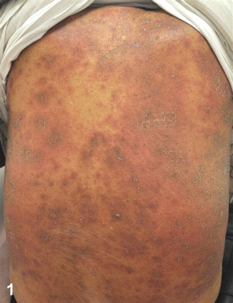 Exfoliative Erythroderma In An 80 Year Old Man Journal Of The