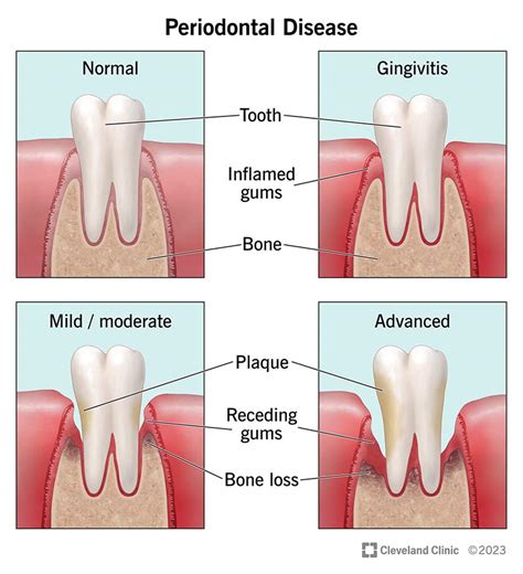 Understanding Different Types Of Gum Disease Influential Smiles