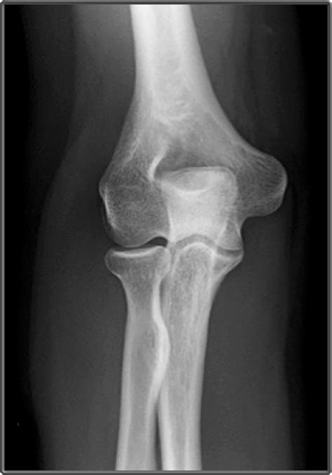 Elbow Anatomy Xray