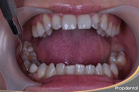 ¿qué Es El Curetaje Dental Curetaje Dental Por Cuadrantes