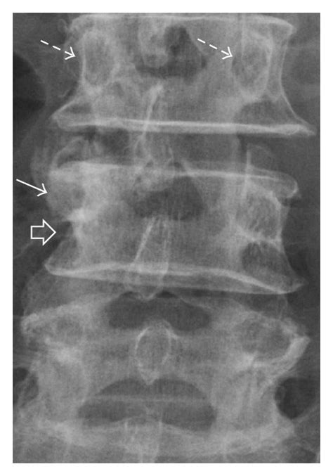 Localised Anteroposterior View Of Lumbosacral Radiograph Showing